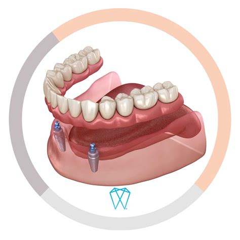 implant supported dentures melbourne fl